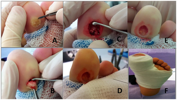 Six-panel clinical photograph series showing the steps of surgical excision of a plantar wart: (A) perilesional scalpel incision with tourniquet applied, (B) tumor extraction using forceps and spoon, (C) curettage of the cavity, (D) saline irrigation, (E) the open surgical cavity after excision, (F) post-surgical bandaging