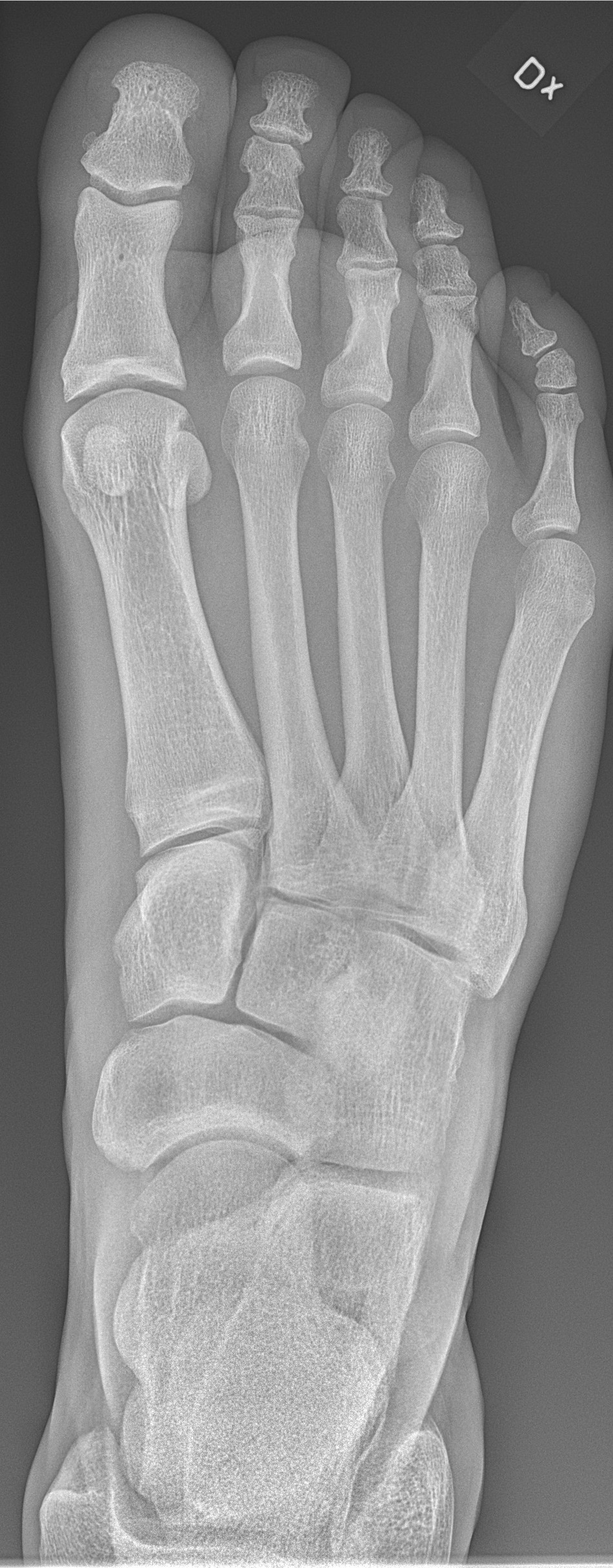X-ray of normal right foot
